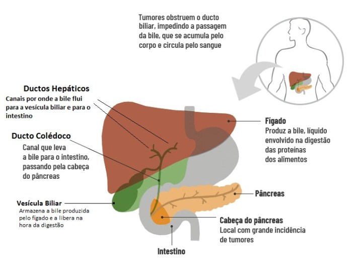 modified from httpsjornal.usp.brcienciasciencias-da-saudetecnica-inovadora-reativa-circulacao-da-bile-e-melhora-qualidade-de-vida-no-cancer
